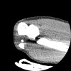 SPORK, NICO - 22.03.1976 - 02.08.2022 - CT obere Extremität - 17:51:17